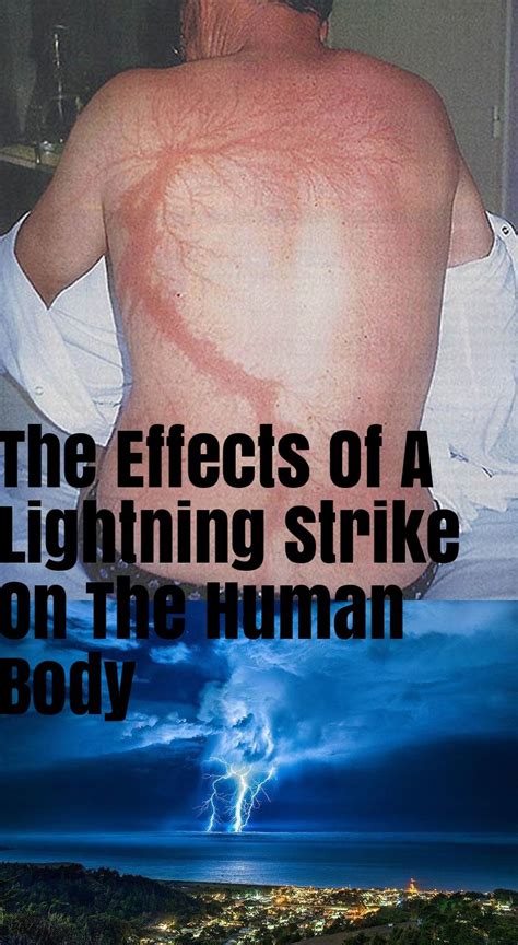 Struck By Lightning: Health Effects and What It Does to the Body.